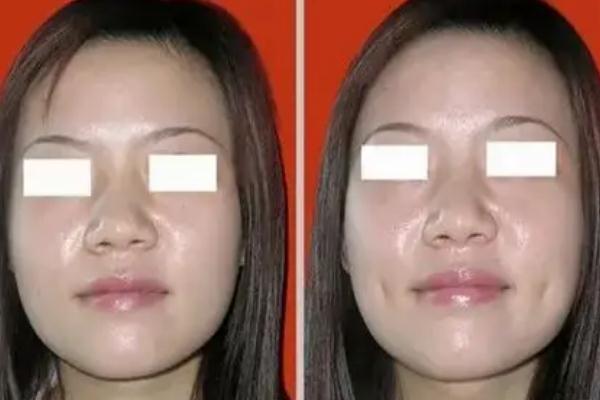 人造酒窩有點(diǎn)疼吃什么藥好 人造酒窩后如何消腫 人造酒窩有點(diǎn)疼吃什么藥好 人造酒窩后如何消腫