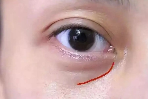 淚溝填充可以維持多久 淚溝填充多久才能恢復(fù)自然 淚溝填充可以維持多久 淚溝填充多久才能恢復(fù)自然