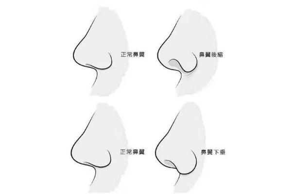 朝天鼻矯正一般多少錢 朝天鼻矯正風(fēng)險大嗎