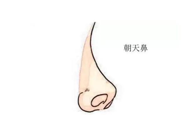 朝天鼻矯正一般多少錢 朝天鼻矯正風(fēng)險大嗎