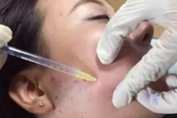 溶脂針的效果和副作用 溶脂針價(jià)格多少錢一針