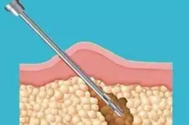 溶脂針的效果和副作用 溶脂針價(jià)格多少錢一針