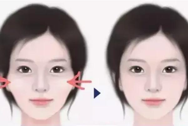 顴骨內(nèi)推要開刀嗎 顴骨內(nèi)推有生命危險(xiǎn)嗎