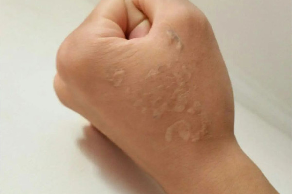 洗紋身敷麻藥嗎 洗紋身敷麻藥對(duì)人體有沒(méi)有傷害 洗紋身敷麻藥嗎 洗紋身敷麻藥對(duì)人體有沒(méi)有傷害