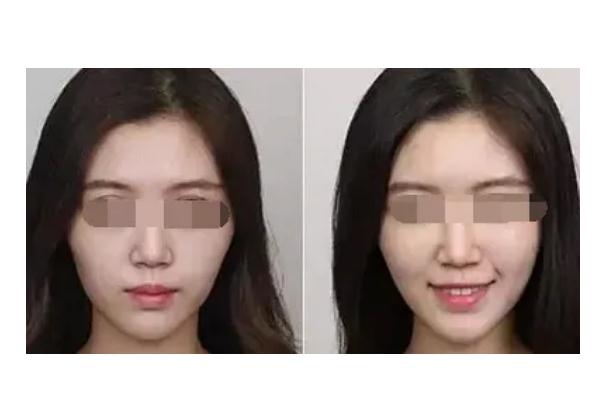 蘋果肌復(fù)位的注意事項 蘋果肌復(fù)位后要戴面罩嗎