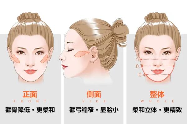 顴骨內推手術多少錢啊 顴骨內推后遺癥