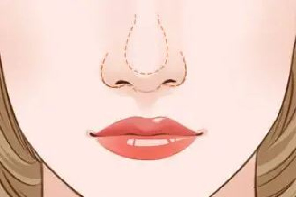 武漢鼻翼縮小好的醫(yī)院 武漢鼻翼縮小手術(shù)多少錢