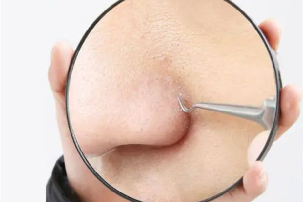 光谷思雨伊人美容養(yǎng)生店小氣泡去黑頭項(xiàng)目值得推薦嗎 小氣泡去黑頭幾次能干凈 光谷思雨伊人美容養(yǎng)生店小氣泡去黑頭項(xiàng)目值得推薦嗎 小氣泡去黑頭幾次能干凈