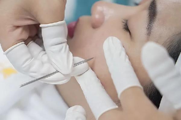 光谷天地花遇·容顏管理店針清效果怎么樣 針清祛痘有用嗎 光谷天地花遇·容顏管理店針清效果怎么樣 針清祛痘有用嗎