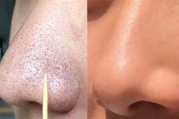 菱角湖SOR索爾祛痘?面部肌膚科學(xué)管理去黑頭效果怎么樣 去黑頭會(huì)留疤嗎 菱角湖SOR索爾祛痘?面部肌膚科學(xué)管理去黑頭效果怎么樣 去黑頭會(huì)留疤嗎