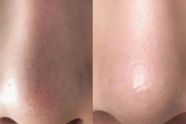 菱角湖SOR索爾祛痘?面部肌膚科學(xué)管理去黑頭效果怎么樣 去黑頭會(huì)留疤嗎 菱角湖SOR索爾祛痘?面部肌膚科學(xué)管理去黑頭效果怎么樣 去黑頭會(huì)留疤嗎