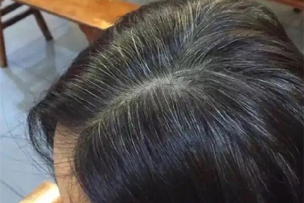 白頭發(fā)多是體內(nèi)缺少什么元素 白頭發(fā)補(bǔ)維生素b幾 白頭發(fā)多是體內(nèi)缺少什么元素 白頭發(fā)補(bǔ)維生素b幾
