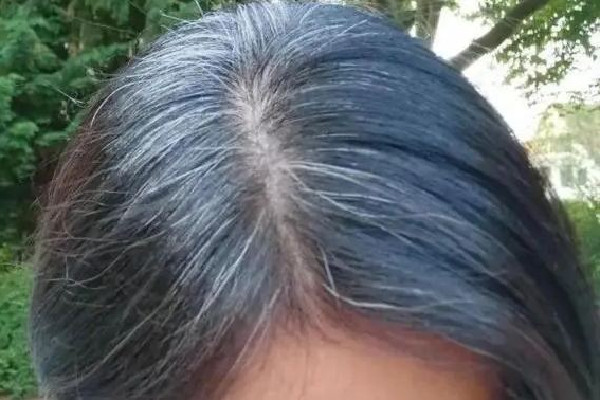 白頭發(fā)越來(lái)越多是身體哪里有問題 白頭發(fā)多和腎虛有關(guān)系嗎