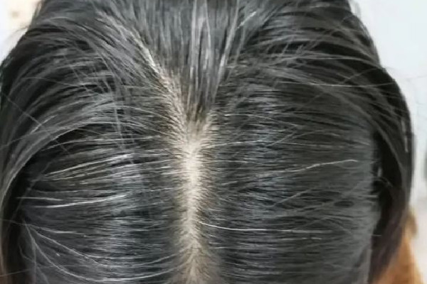 白頭發(fā)從哪開(kāi)始白 白頭發(fā)為什么會(huì)越來(lái)越多