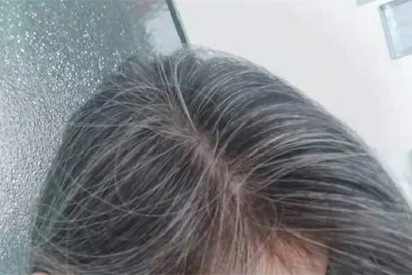 白頭發(fā)從哪開(kāi)始白 白頭發(fā)為什么會(huì)越來(lái)越多