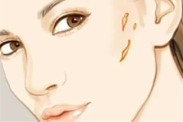 中南路正璞醫(yī)療美容·痘坑疤痕&皮膚微整店祛疤效果怎么樣 祛疤會越來越嚴(yán)重嗎 中南路正璞醫(yī)療美容·痘坑疤痕&皮膚微整店祛疤效果怎么樣 祛疤會越來越嚴(yán)重嗎