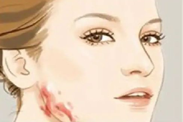 中南路欣奕除疤祛痘全國連鎖機(jī)構(gòu)祛疤效果怎么樣 祛疤是越早越好嗎