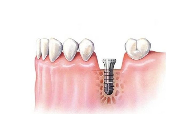 多地調(diào)低種植牙醫(yī)療服務(wù)費(fèi)用 種牙醫(yī)保能報銷嗎 多地調(diào)低種植牙醫(yī)療服務(wù)費(fèi)用 種牙醫(yī)保能報銷嗎