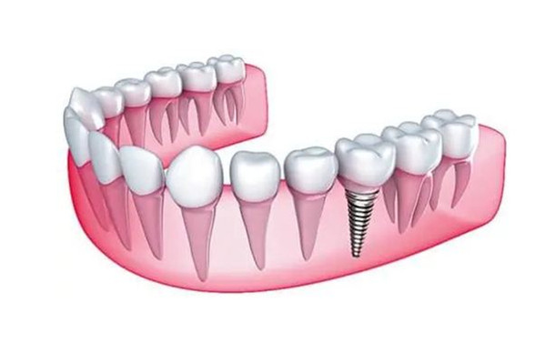 多地調(diào)低種植牙醫(yī)療服務(wù)費(fèi)用 種牙醫(yī)保能報銷嗎 多地調(diào)低種植牙醫(yī)療服務(wù)費(fèi)用 種牙醫(yī)保能報銷嗎